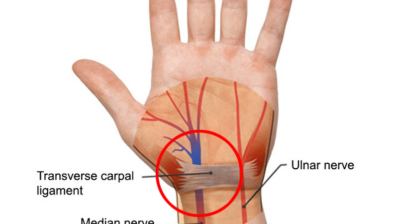 Carpal Tunnel Syndrome
